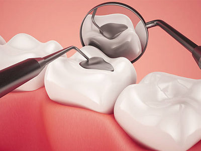 Composite Fillings - Restorative Dentist in Kyle, TX