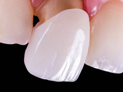 Dental Crowns - Restorative Dentist in Kyle, TX