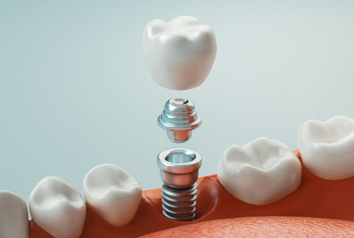 Dental Implants in Kyle, TX
