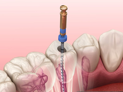 Root Canal Therapy - Restorative Dentist in Kyle, TX