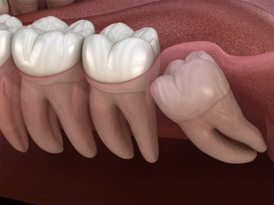 Wisdom Teeth Removal - Restorative Dentist in Kyle, TX