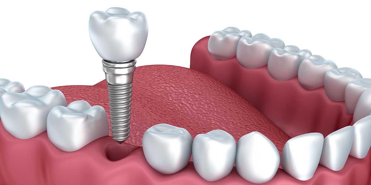 Single tooth implant