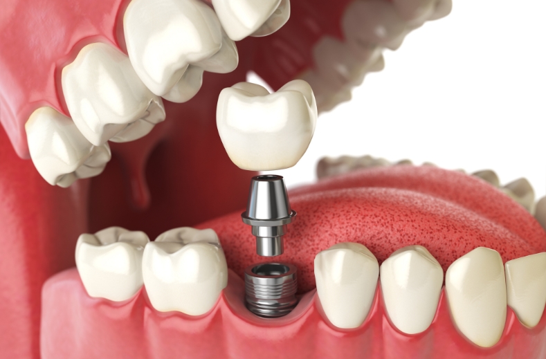 Why Dental Implants Are A Long-Term Investment In Your Smile?